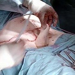 Abdominal Phalloplasty