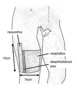 ALT Phalloplasty. Source: Phalloplasty with an Innervated Island Pedicled Anterolateral Thigh Flap in a Female-to-Male Transsexual