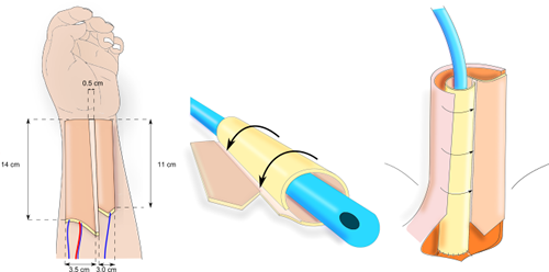 Tube-Within-a-Tube Phalloplasty