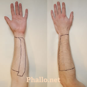 Hair Removal for RFF Phalloplasty