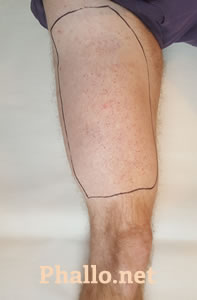 Hair Removal for ALT Phalloplasty