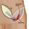 Pedicled Flap Phalloplasty