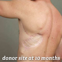 Re-innervated Latissimus Dorsi Free Flap