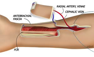 RFF Phalloplasty