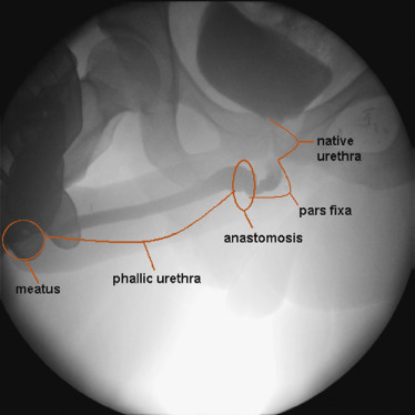 transsexual urethra